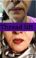 Thread Lift Is One Stitch Facelift