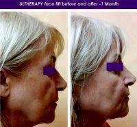 Ultherapy Facelift Before And After 1 Month