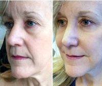 With Liquid Facelift Sagging Skin Can Be Lifted And Filled Out