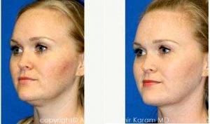 38 Year Old Woman Treated With Facelift Before & After By Dr Amir M. Karam, MD, San Diego Facial Plastic Surgeon