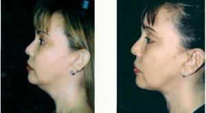 39 Year Old Woman Treated With Facelift Before & After By Dr Robert H. Hunsaker, MD, Miami Plastic Surgeon