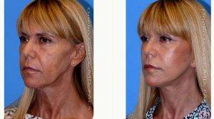 48 Year Old Woman Treated With Facelift Before & After By Doctor Onelio Garcia Jr, MD, FACS, Miami Plastic Surgeon