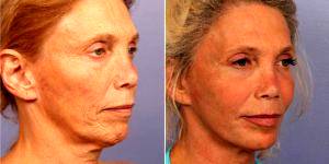 48 Year Old Woman Treated With Facelift Before & After By Dr Grant Stevens, MD, Los Angeles Plastic Surgeon