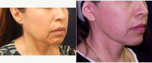 49 Year Old Woman Treated With Facelift Before & After By Dr Vaishali B. Doolabh, MD, FACS, Jacksonville Plastic Surgeon