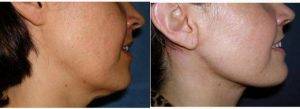 49 Year Old Woman Treated With Facelift By Dr Hector Milla, MD, Mexico Plastic Surgeon