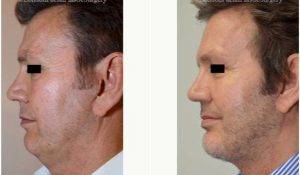 50 Year Old Man Treated With Facelift Before And After By Dr Julian De Silva, MD, London Oculoplastic Surgeon