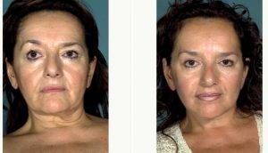 50 Year Old Woman Treated With Facelift Before & After By Dr. Burton M. Sundin, MD, Richmond Plastic Surgeon
