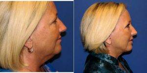50 Year Old Woman Treated With Facelift Before & After With Dr Gregory T. Lynam, MD, Richmond Plastic Surgeon