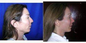 51 Year Old Woman Treated With Facelift And Rhinoplasty By Dr. Manuel Gutierrez Romero, MD, Mexico Plastic Surgeon