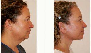 51 Year Old Woman Treated With Facelift Before & After By Dr. Dino R. Elyassnia, MD, San Francisco Plastic Surgeon