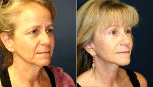 52 Year Old With Premature Aging Before & After By Doctor Steve Laverson, MD, San Diego Plastic Surgeon