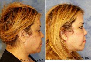 54 Year Old Woman Treated With Facelift Before & After With Dr. Wendell Perry, MD, Miami Plastic Surgeon