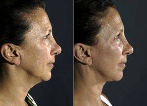 55 Year Old Woman Treated For Facial Aging Before & After By Dr. Marcelo Ghersi, MD, Miami Plastic Surgeon