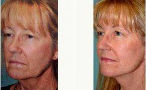 56 Year Old Woman - Facelift Before & After With Doctor David J. Kiener, MD, Sacramento Facial Plastic Surgeon