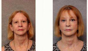 57 Year Old Woman Treated With Facelift Before & After By Doctor Christian G. Drehsen, MD, Tampa Plastic Surgeon