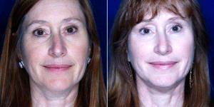 57 Year Old Woman Treated With Facelift Before & After With Doctor Stephen J. Ronan, MD, FACS, San Francisco Plastic Surgeon
