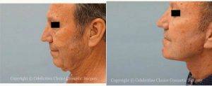 58 Year Old Man Treated With Facelift Before & After By Dr. Thomas Trevisani, Sr., MD, Orlando Plastic Surgeon