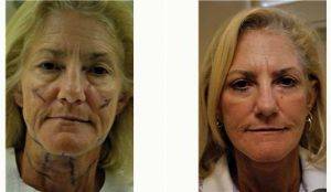 58 Year Old Woman Treated With Facelift Before & After By Dr. D. Scott Rotatori, MD, Orlando Plastic Surgeon
