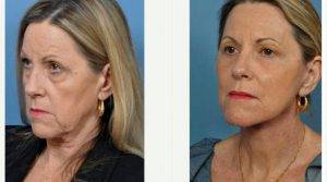 58 Year Old Woman Treated With Facelift Before & After By Dr. Roberto E. Garcia, MD, FACS, Jacksonville Facial Plastic Surgeon