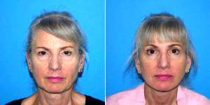 59 Year Old Woman Treated With Facelift Before & After By Dr Kyle S. Choe, MD, Virginia Beach Facial Plastic Surgeon