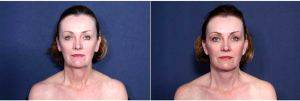 60 Year Old Woman Treated With Facelift Before & After By Doctor H. Michael Roark, MD, San Diego Plastic Surgeon