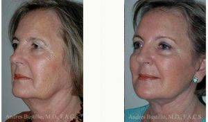 61 Year Old Woman Treated With Facelift Before & After With Doctor Andres Bustillo, MD, FACS, Miami Facial Plastic Surgeon