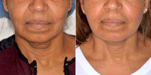 62 Year Old Woman Treated With Facelift Before & After By Dr. Anthony Bared, MD, FACS, Miami Facial Plastic Surgeon
