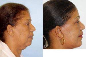 63 Year Old Woman Treated With Facelift Before & After With Dr. Sam Gershenbaum, DO, Miami Plastic Surgeon