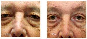 64 Year Old Man Treated With Browlift Before & After By Doctor Nadia P. Blanchet, MD, Richmond Plastic Surgeon