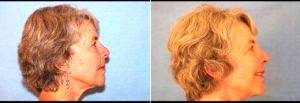 66 Year Old Woman Treated For Facelift Before & After With Dr. James C. Pietraszek, MD, San Diego Plastic Surgeon