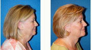 66 Year Old Woman Treated With Facelift Before & After By Doctor Joseph R. Coscia, MD, Sacramento Plastic Surgeon