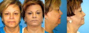 66 Year Old Woman With Facelift With Doctor William LoVerme, MD, Boston Plastic Surgeon