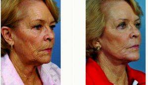 69 Year Old Woman Treated With Facelift Before & After By Dr J. Phillip Garcia, MD, FACS, Jacksonville Facial Plastic Surgeon