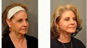 69 Year Old Woman Treated With Facelift Before & After With Dr Gilbert Lee, MD, San Diego Plastic Surgeon