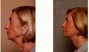 72 Year Old Woman Treated With A Refresher Lift By Dr Christian G. Drehsen, MD, Tampa Plastic Surgeon