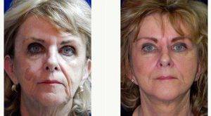 73 Year Old Woman Treated With Facelift By Doctor Anna Petropoulos, MD, FRCS, Boston Facial Plastic Surgeon