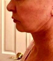 A Lower Face And Necklift