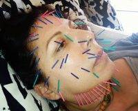 Acupuncture Face Lift In Kansas City