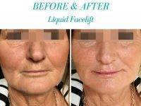 Before & After Liquid Facelift Photo