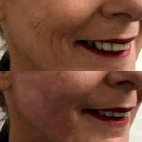 Before And After Cheek Filler Photos