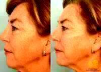Before And After Liquid Dermal Fillers