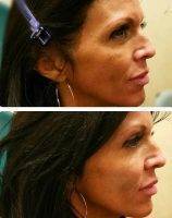 Before And After Liquid Facelift In Minnesota