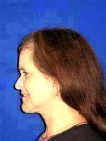 Before And After Lower Facelift With Neck Lift (1)