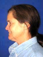 Before And After Lower Facelift With Neck Lift (3)
