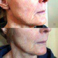 Before And After Nuface Microcurrent Facial Toning