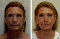 Before And After Plastic Face Surgery With Dr. William R. Burden