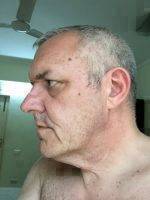 Before Male Facelift
