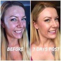 Botox 7 Days After