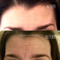 Botox Before And After Allergan (2)