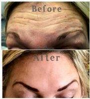 Botox Before And After Allergan (3)